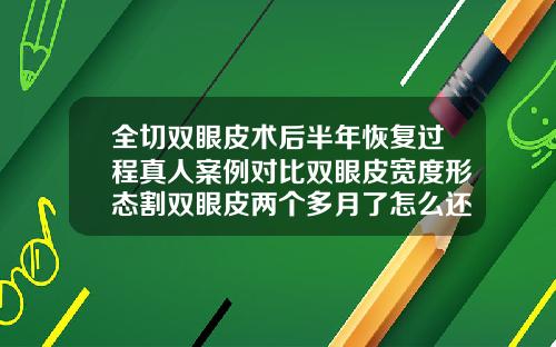 全切双眼皮术后半年恢复过程真人案例对比双眼皮宽度形态割双眼皮两个多月了怎么还不自然呢