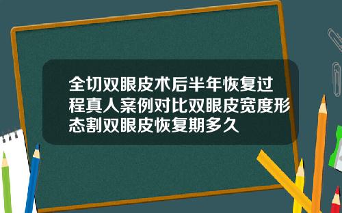 全切双眼皮术后半年恢复过程真人案例对比双眼皮宽度形态割双眼皮恢复期多久