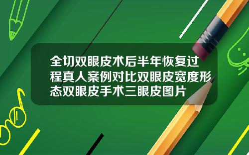 全切双眼皮术后半年恢复过程真人案例对比双眼皮宽度形态双眼皮手术三眼皮图片