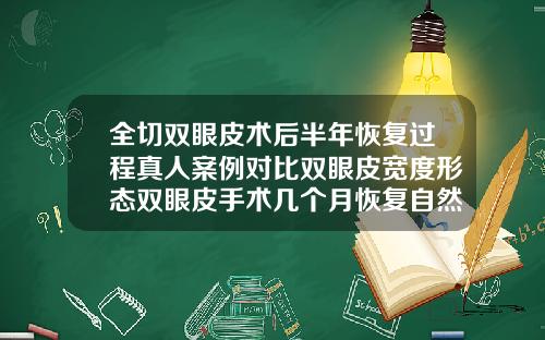 全切双眼皮术后半年恢复过程真人案例对比双眼皮宽度形态双眼皮手术几个月恢复自然