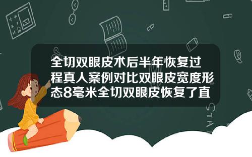 全切双眼皮术后半年恢复过程真人案例对比双眼皮宽度形态8毫米全切双眼皮恢复了直观多宽