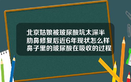北京姑娘被玻尿酸坑太深半肋鼻修复后近6年现状怎么样鼻子里的玻尿酸在吸收的过程中会变宽吗
