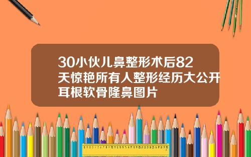 30小伙儿鼻整形术后82天惊艳所有人整形经历大公开耳根软骨隆鼻图片