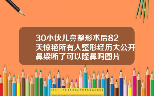 30小伙儿鼻整形术后82天惊艳所有人整形经历大公开鼻梁断了可以隆鼻吗图片