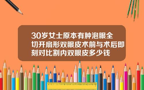 30岁女士原本有肿泡眼全切开扇形双眼皮术前与术后即刻对比割内双眼皮多少钱