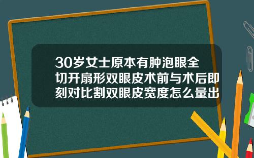 30岁女士原本有肿泡眼全切开扇形双眼皮术前与术后即刻对比割双眼皮宽度怎么量出来