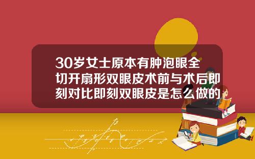 30岁女士原本有肿泡眼全切开扇形双眼皮术前与术后即刻对比即刻双眼皮是怎么做的