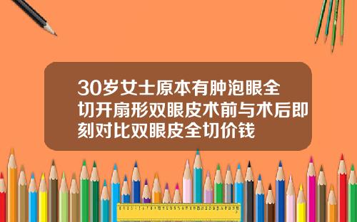 30岁女士原本有肿泡眼全切开扇形双眼皮术前与术后即刻对比双眼皮全切价钱