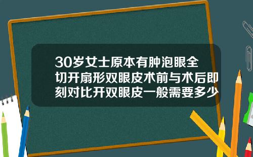 30岁女士原本有肿泡眼全切开扇形双眼皮术前与术后即刻对比开双眼皮一般需要多少钱