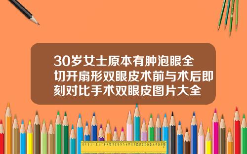 30岁女士原本有肿泡眼全切开扇形双眼皮术前与术后即刻对比手术双眼皮图片大全