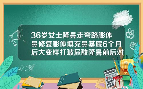 36岁女士隆鼻走弯路膨体鼻修复膨体填充鼻基底6个月后大变样打玻尿酸隆鼻前后对比