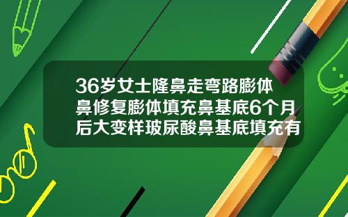 36岁女士隆鼻走弯路膨体鼻修复膨体填充鼻基底6个月后大变样玻尿酸鼻基底填充有什么后遗症