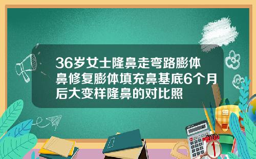 36岁女士隆鼻走弯路膨体鼻修复膨体填充鼻基底6个月后大变样隆鼻的对比照