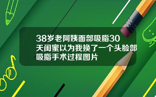 38岁老阿姨面部吸脂30天闺蜜以为我换了一个头脸部吸脂手术过程图片